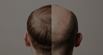 Hair Shedding vs. Hair Loss: What You Need to Know